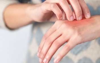 Problemas de piel causados por las mascarillas y geles anti-Covid: persona arrascandose la mano con una erupción