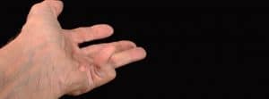 Enfermedad de Dupuytren: rigidez y pérdidad de flexibilidad en los dedos: mano con el dedo meñique encogido