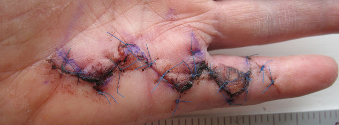 Enfermedad de Dupuytren: mano con cicatriz por una operación