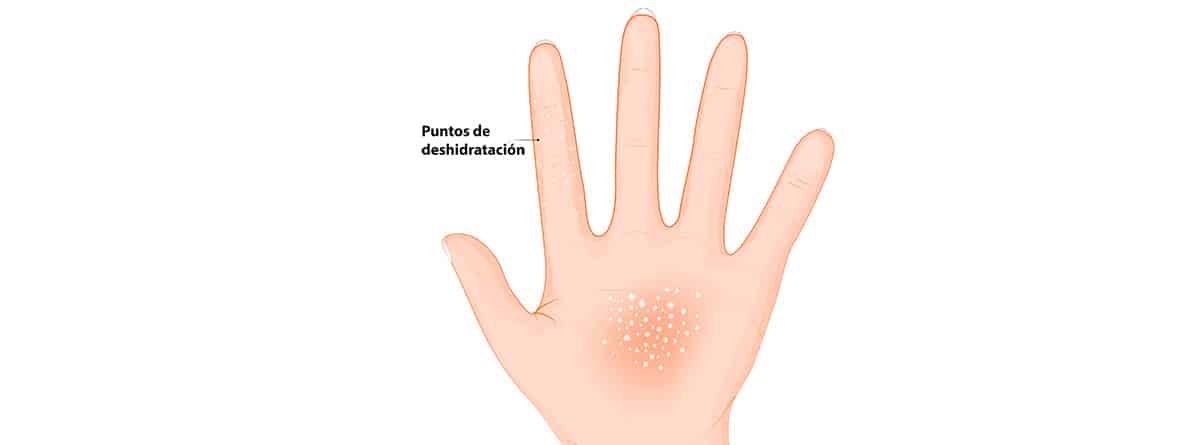 dishidrosis, mano con puntos de dermatitis