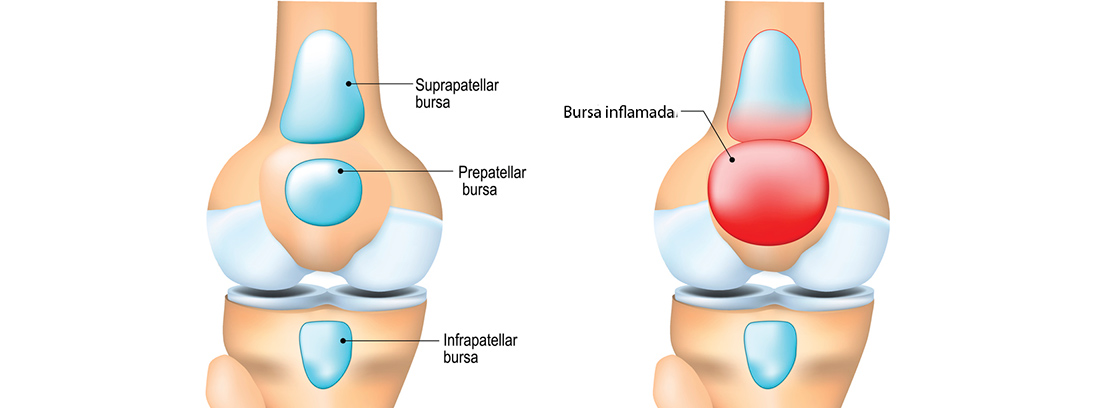 Bursitis de rodilla: esquema de bursitis de rodilla