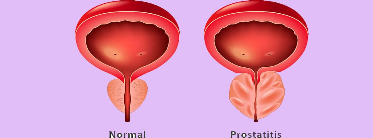 Prostatitis: dibujo de dos próstatas, una normal y la otra con prostatitis