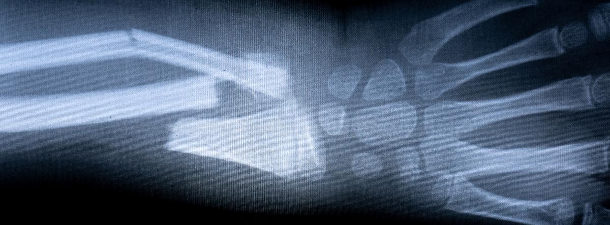 Diferencia entre fisura ósea y fractura de hueso: radiografía de fractura de mano