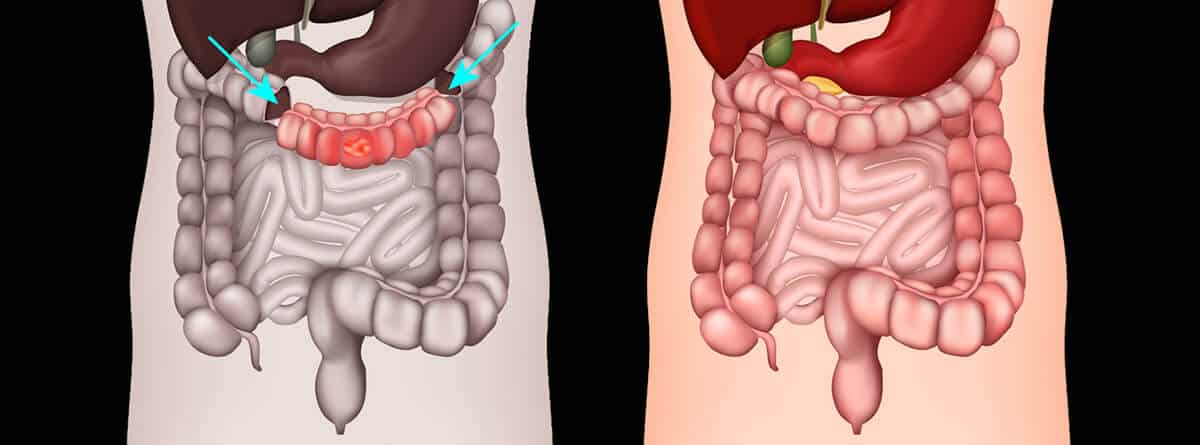 ¡Qué es una colectomía y cuál es su recuperación?: esquema de colectomía