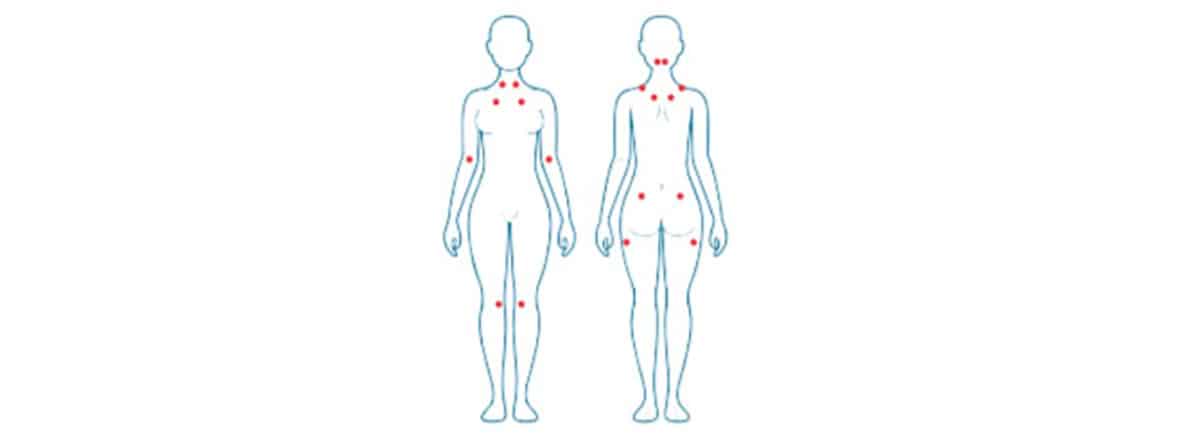 Puntos de fibromialgia: dibujo de cuerpo humano con puntos en rojo