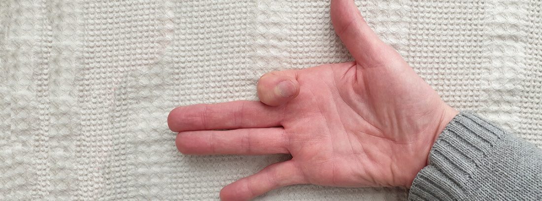 Capsulitis o inflamaciones de las articulaciones de los dedos: mano con el dedo índice cerrado