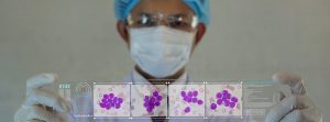 doctor con muestras de sangre con células de leucemia crónica