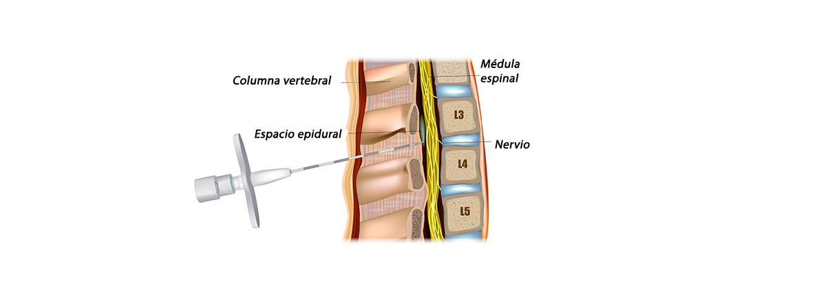 anestesia epidural