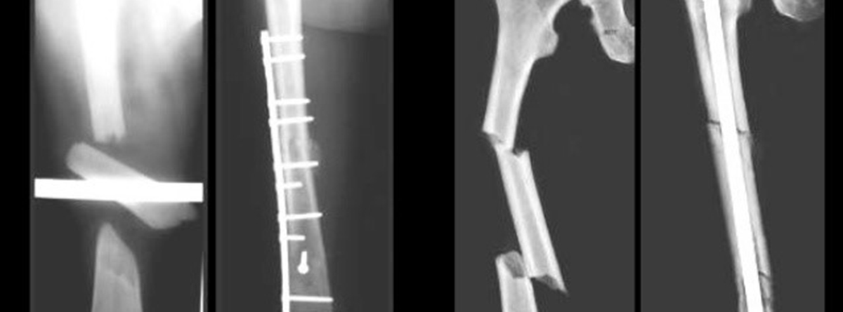 Osteosíntesis: fractura de humero