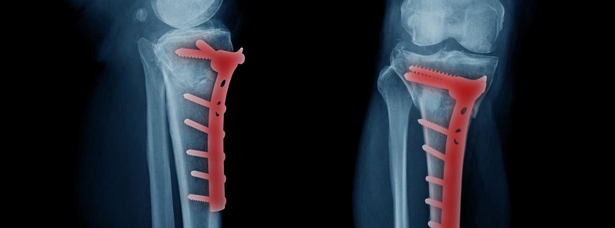 Osteosíntesis: radiografía de fractura