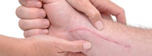 ¿Cómo cuidar las cicatrices? cicatriz en un brazo