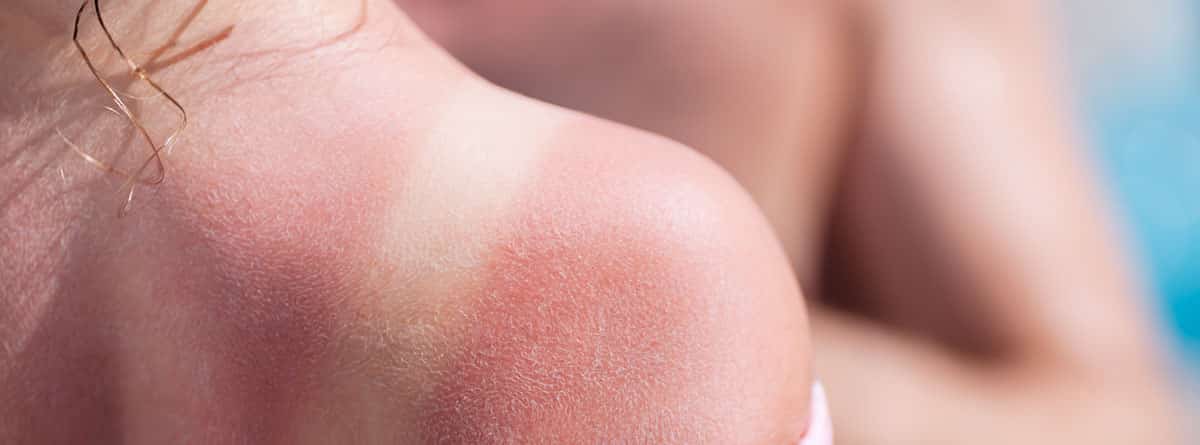 Los males del verano: espalda de mujer con marca de quemadura solar