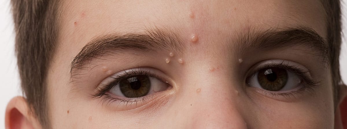 Molusco contagioso: cara de un niño con granitos de molusco