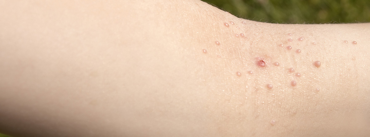 Molusco contagioso: brazo con problema en la piel