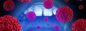 Prevenir el cáncer oral: boca con células de enfermedades malignas con