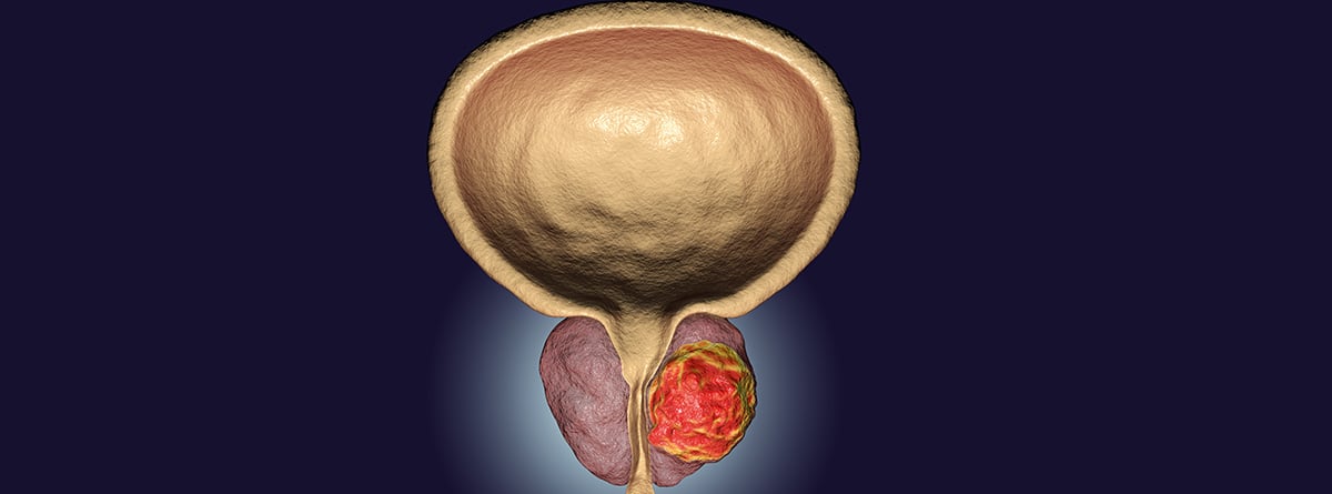 Ilustración del cáncer de próstata