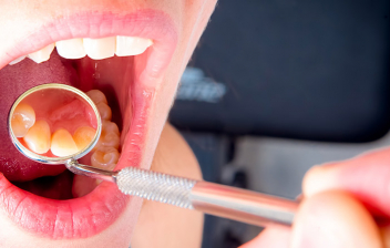 Dientes en el paladar: dentista con lupa observando la boca de un paciente