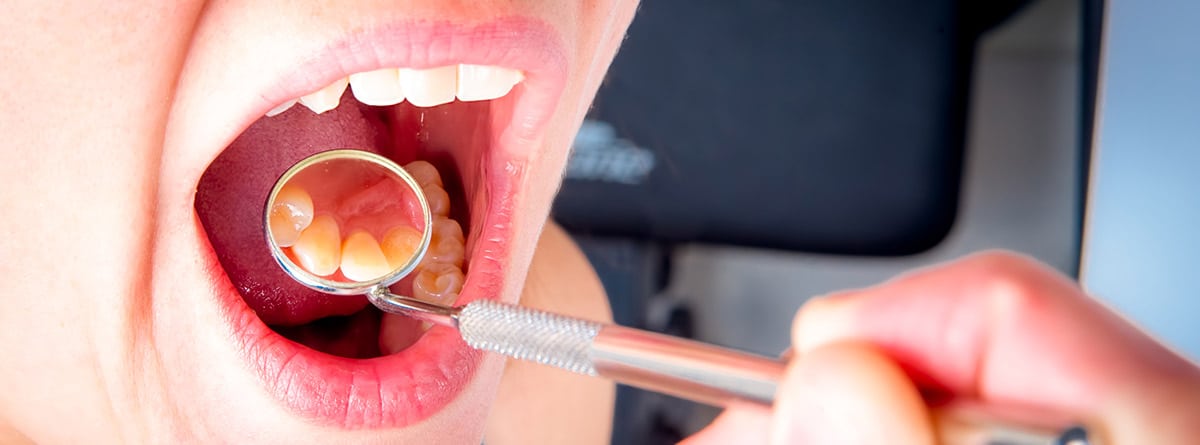 Dientes en el paladar: dentista con lupa observando la boca de un paciente