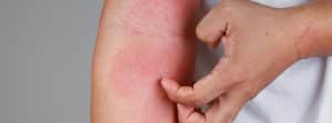 Enfermedad de Wells: picos en un brazo, eczema, dermatitis