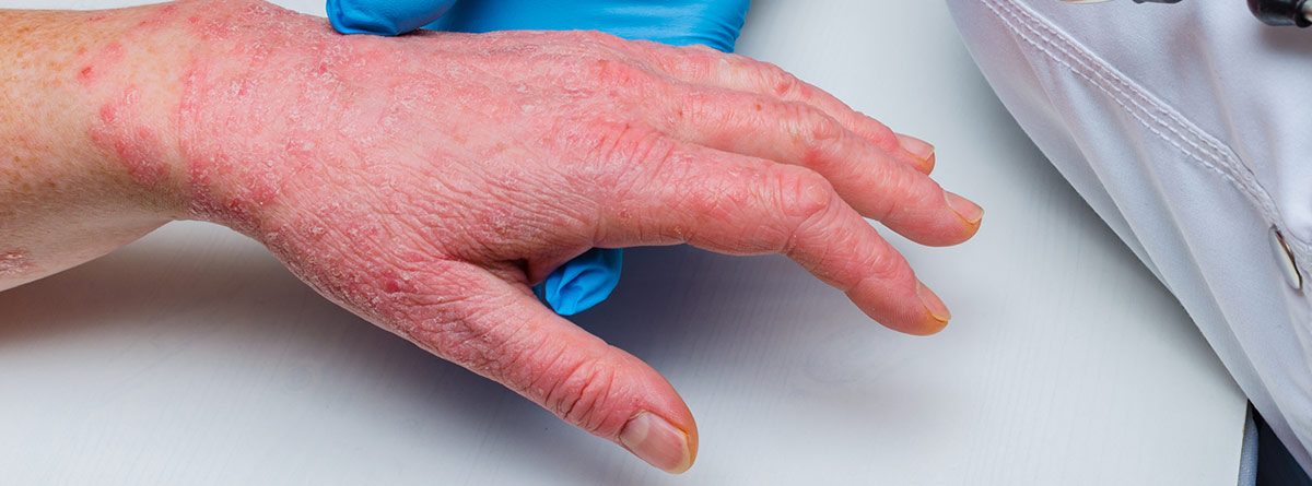 Enfermedad de Wells: Un médico con guantes examina la piel de la mano de un paciente enfermo. 