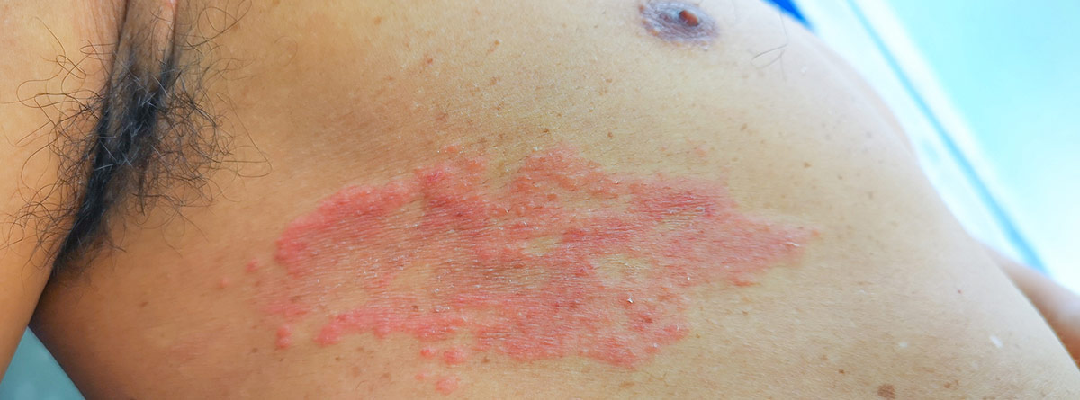 Hidrosadenitis supurativa: problema de la piel debajo de la axila de un hombre