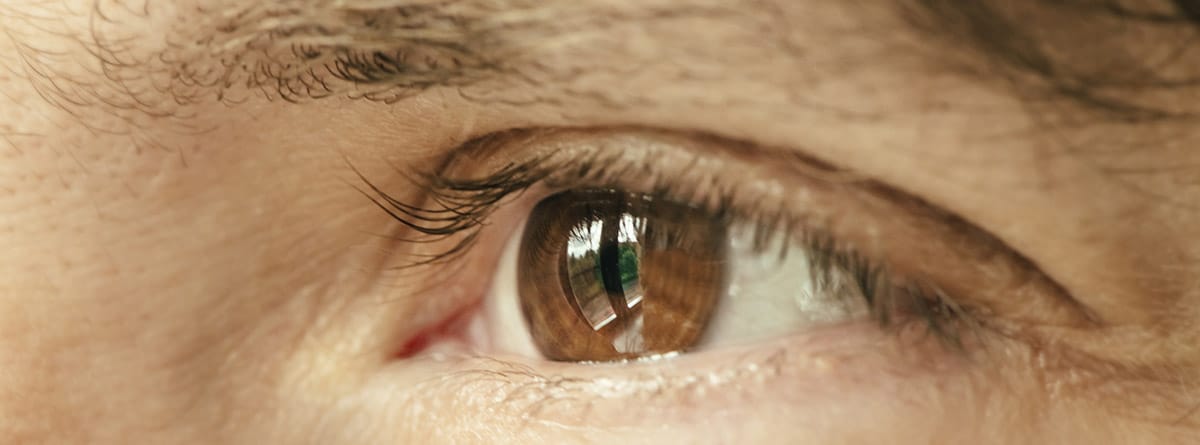 Síndrome de ojo de gato: ojo marrón con una mancha vertical en el iris