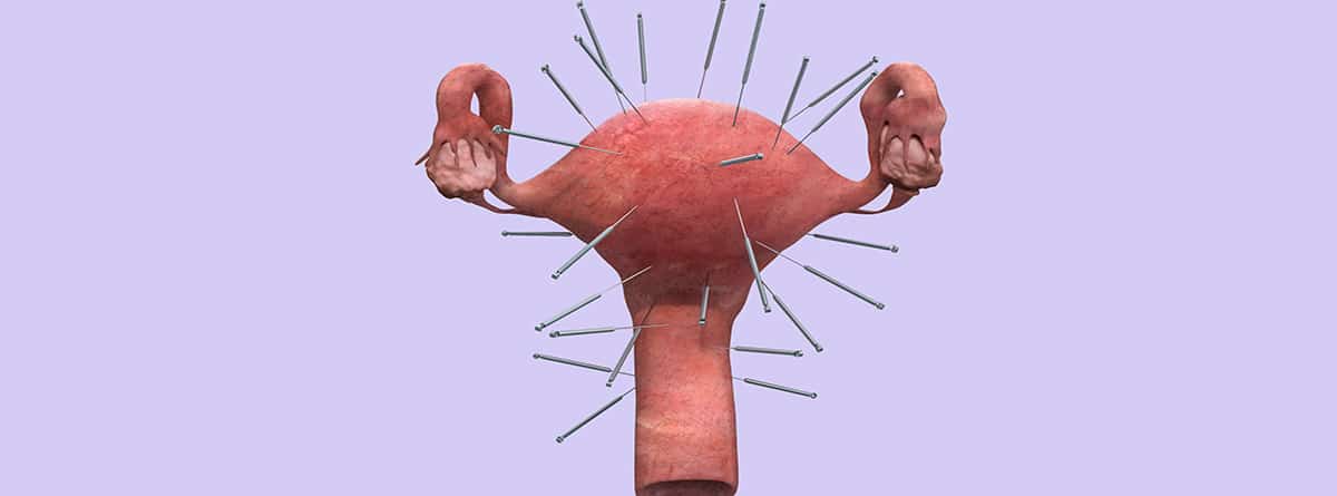 Acupuntura en ginecología y obstetricia: aparato reproductor femenino con agujas de acupuntura