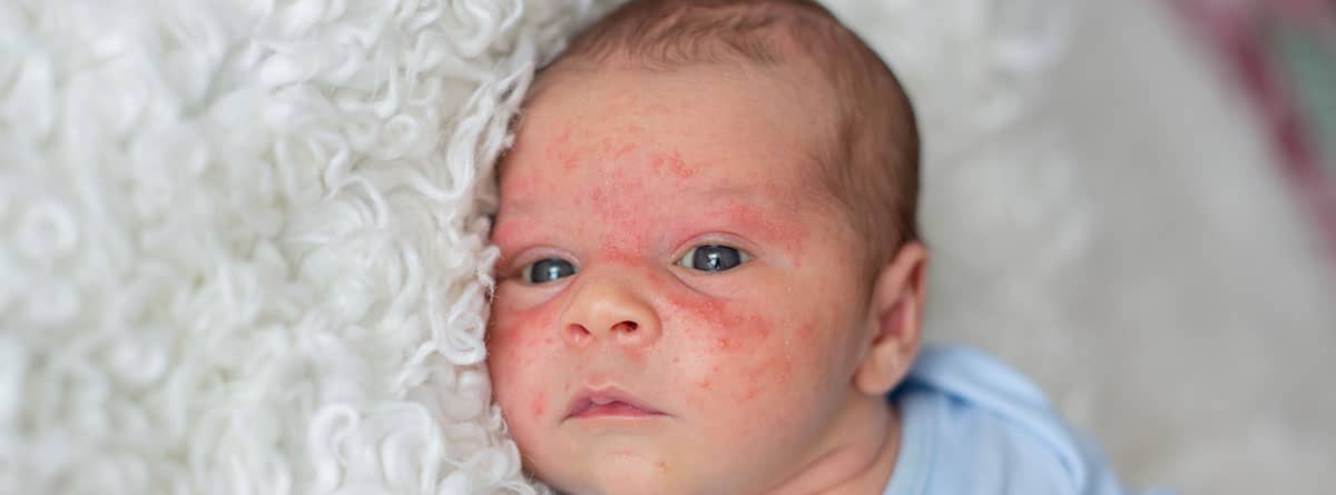 Mancha salmón en bebés: bebé con dermatitis en la cara sobre todo en las cejas