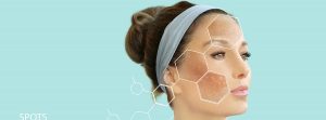 Melasma: mujer con manchas oscuras en el rostro