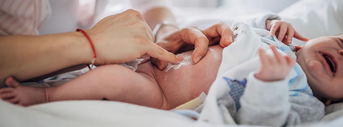 Onfalitis, infección del cordón umbilical: bebé con infección en el ombligo y manos aplicando una pomada