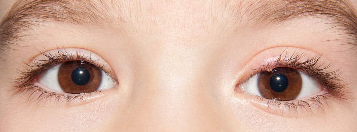 Cara de un niño con un ojo sano y un ojo con un orzuelo