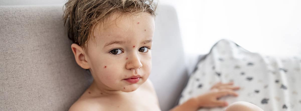Niño pequeño con varicela.