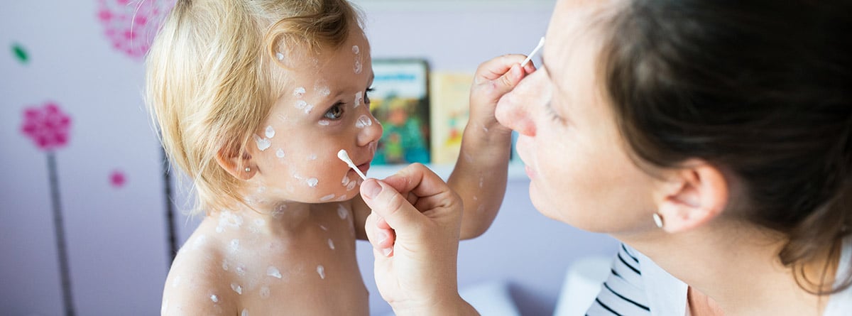 mujer aplicando pomada en cara de niña con varicela