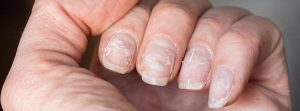 ¿Qué indican las estrías, rayas o cambio de color en las uñas?: uñas con escamas, enfermas