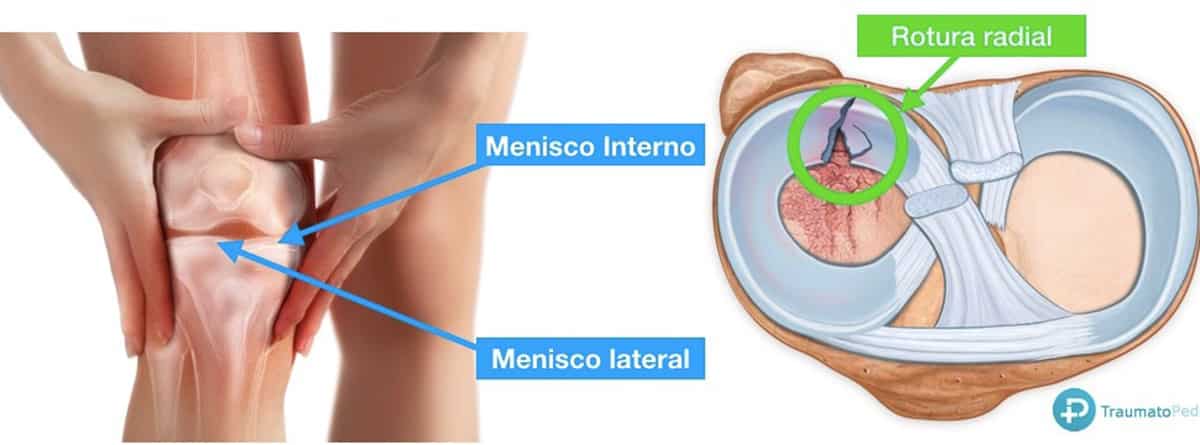 Artroscopia:imagen de menisco sano y menisco roto