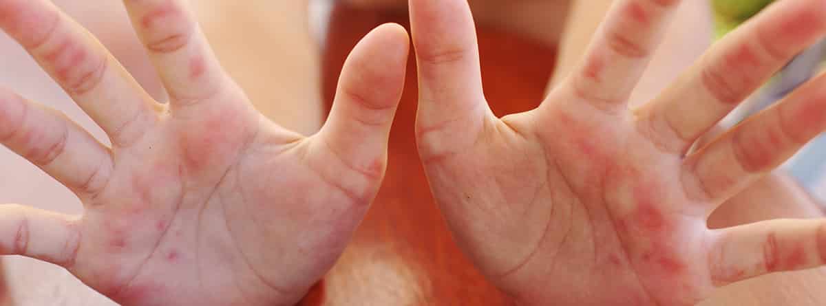 Piel de mariposa: manos extendidas con problemas en la piel