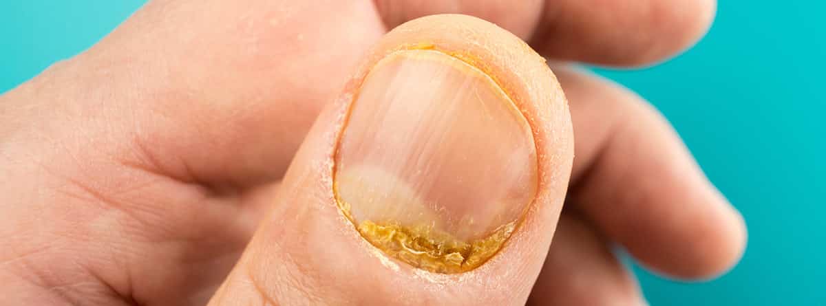 Deformidades distrofias y coloración de las uñas  Trastornos de la piel   Manual MSD versión para público general