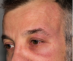 Angioedema: cara de hombre con una alergia cutánea alrededor del ojo