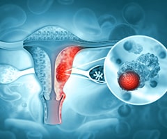 Cáncer de útero: imágen del aparato reproductor femenino con células cancerígenas