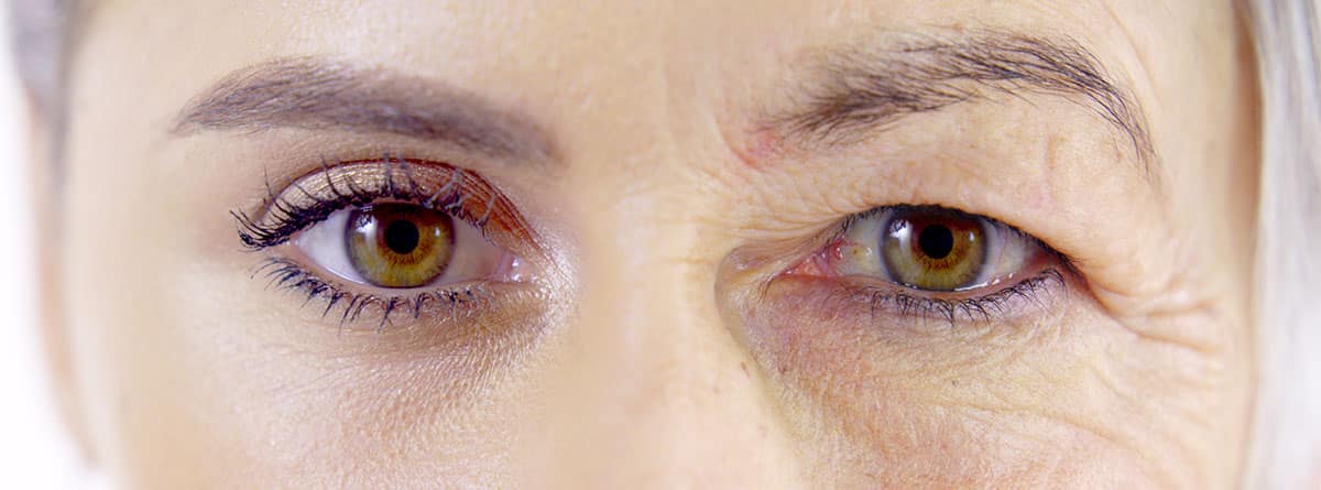 Fasciculaciones oculares: mujer con un ojo más cerrado que el otro