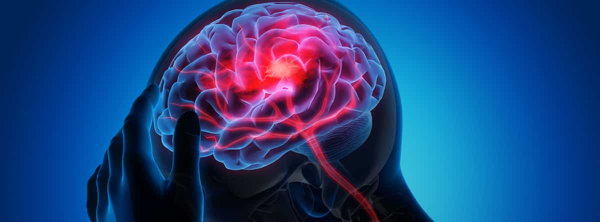 Glioma, tumores cerebrales: imagen de un tumor en el cerebro