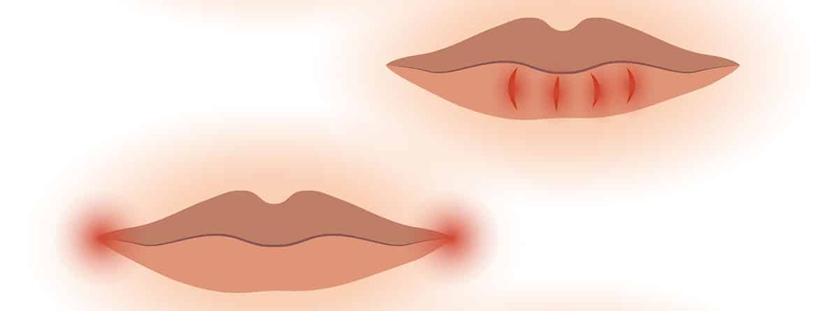 Labios agrietados: imagen de diferentes problemas labiales.