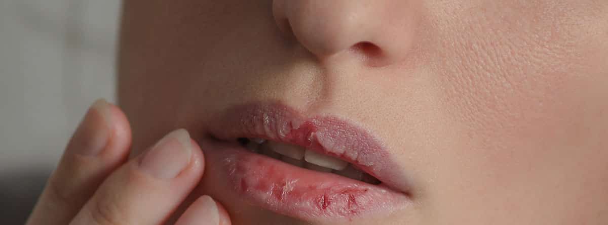 Labios cortados ¿como tratarlos?: medio rostro de la cara de mujer con los labios agrietados