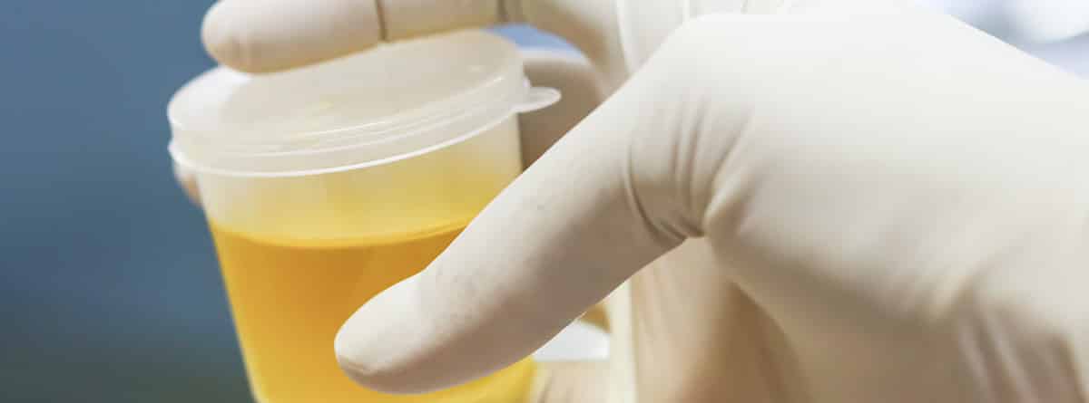 Olor fuerte en la orina: muestra de orina en un recipiente de laboratorio