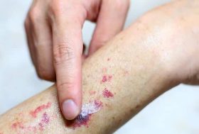 Qué son las petequias y por qué aparecen? brazo con manchas rojas en la piel y tratándola con una pomada