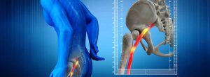 Síndrome piriforme: imagen de cuerpo humano con el nervio ciático resaltado