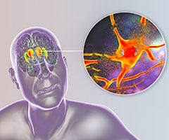 Como detectar la enfermedad de huntington: Cuerpo estriado dorsal, núcleo caudado y putamen, resaltados en el cerebro de una persona con enfermedad de Huntington y vista de primer plano de la degradación neuronal