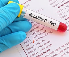 Hepatitis C: tubo test con muestra de sangre para la prueba del virus de la hepatitis C