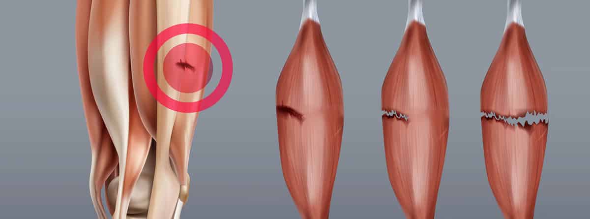 Lesión en el gemelo y el soleo: Ilustración de lesión muscular de la pierna con ruptura en diferentes etapas