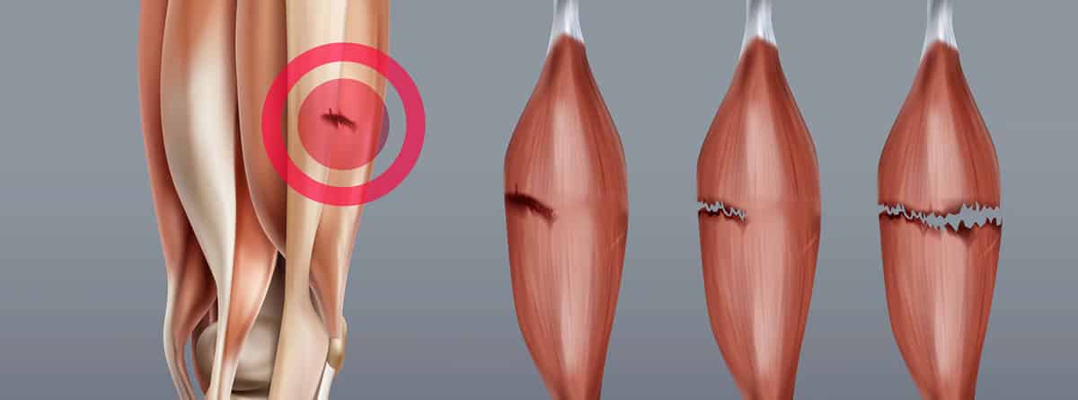 gerente Conflicto Optimismo Lesión de los gemelos y sóleo, causas y tipos -canalSALUD